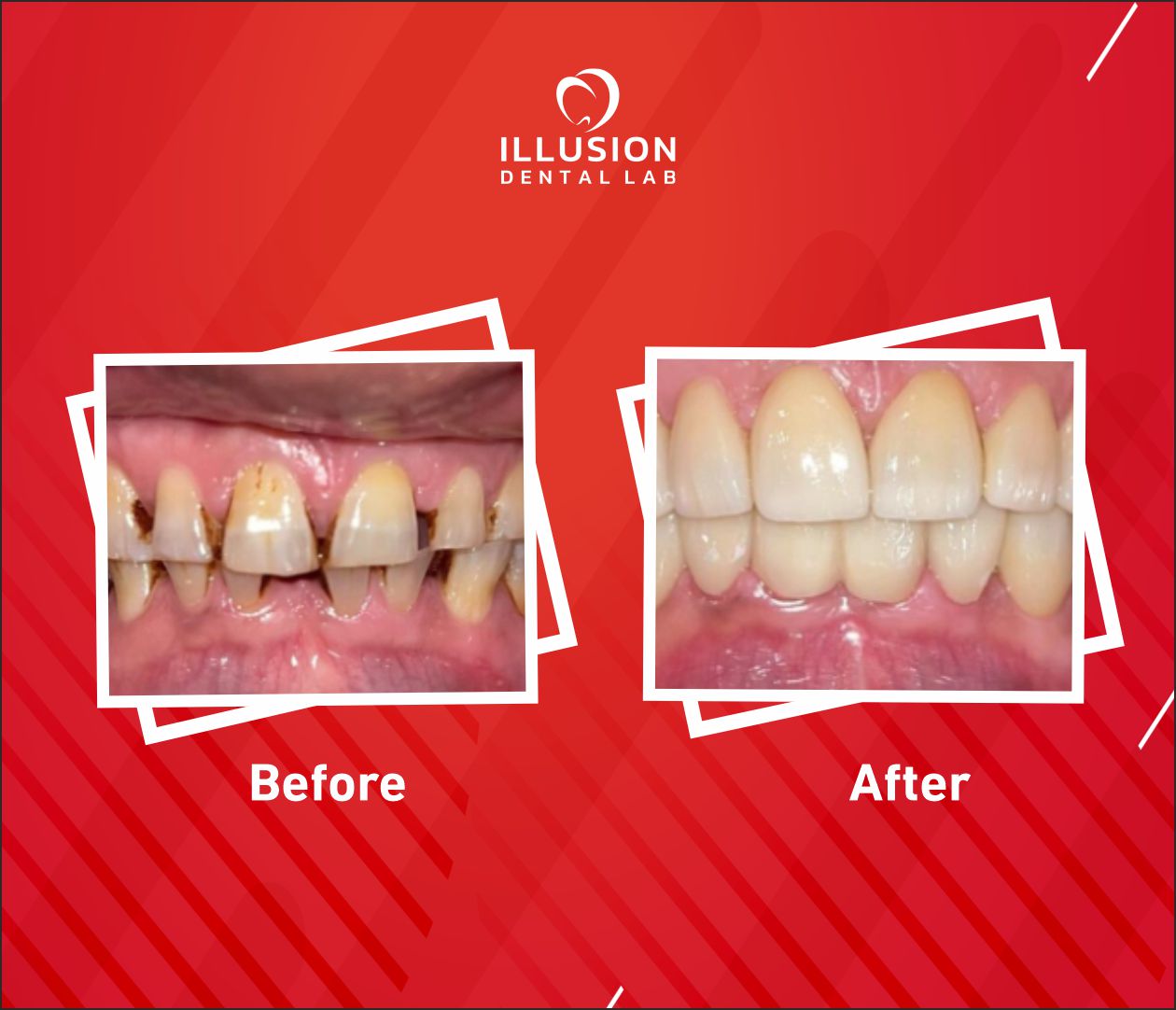 full mouth rehabilitation steps
